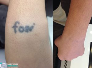 If you don′t like your tattoo, you’re not alone. An estimated 25% of tattooed people experience tattoo regret. Whatever the reason, if you have a tattoo you no longer want, we can help.
